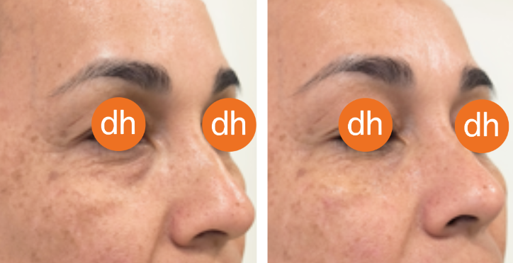 Carboxiterapia-ojeras-clinicas dh