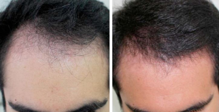 antes-y-despues-bioestimulacion-capilar-clinicas-dh