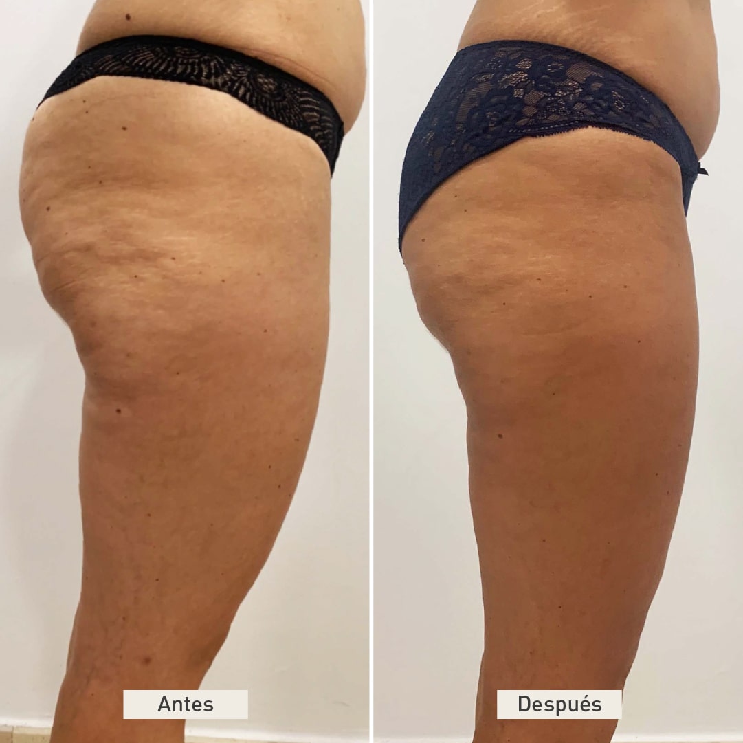 antes-y-despues-carboxiterapia-clinicasdh