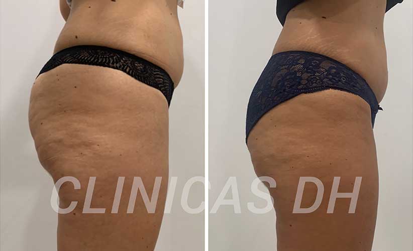 clinicas-dh-tratamientos-esteticos-para-despues-del-parto-carboxiterapia