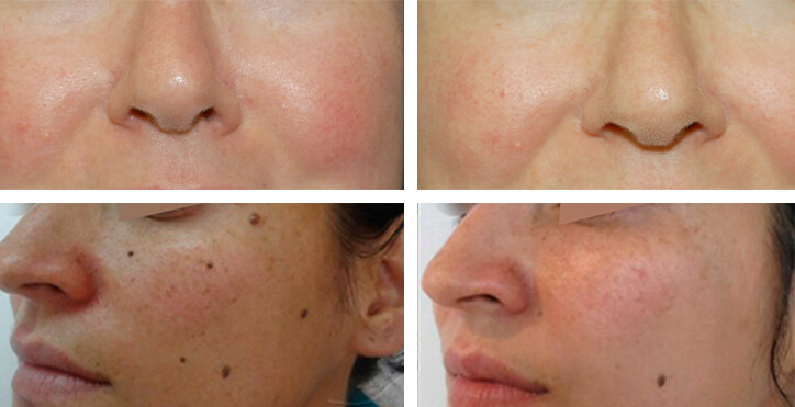 electrocauterio-antes-y-despues-clinicas-dh