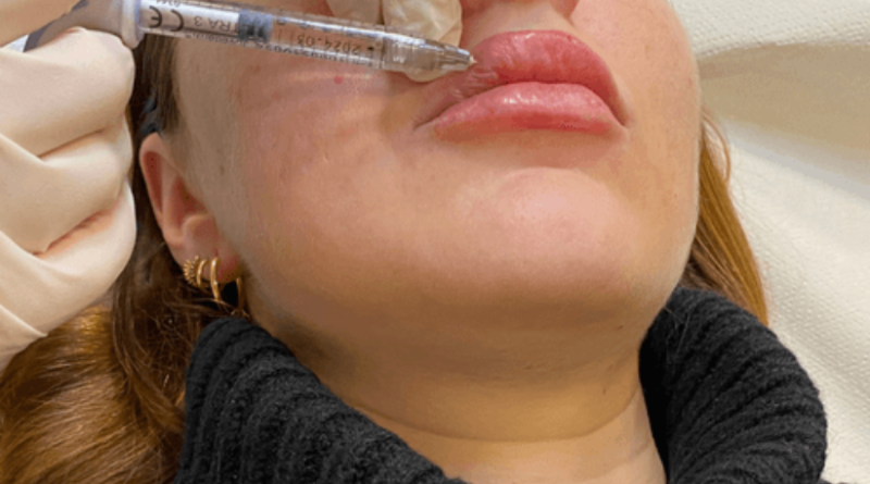 Aumento-de-labios-clinicas-dh