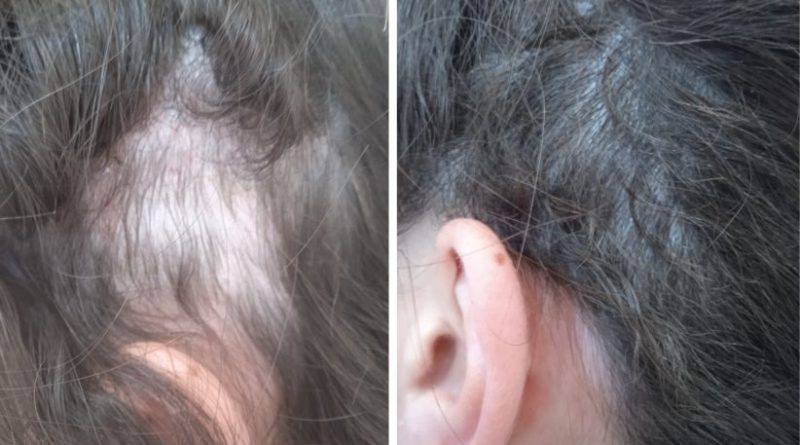 bioestimulacion-capilar-clinicas-dh