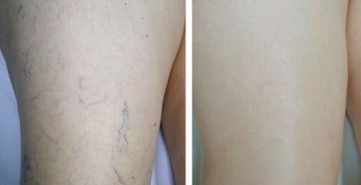 escleroterapia-clinicas-dh