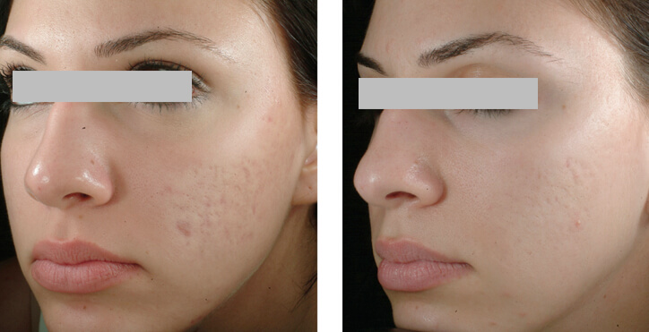 microdermoabrasion-antes-y-despues