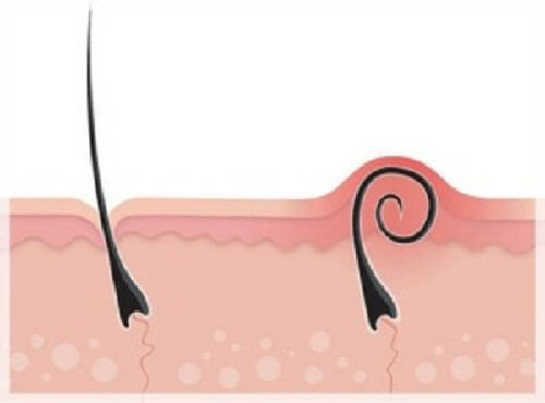 Como solucionar la foliculitis