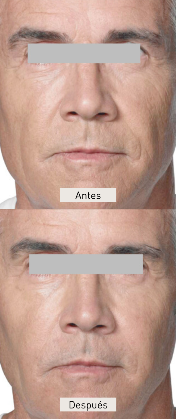 radiesse-prevencion-envejecimiento-clinicas-dh