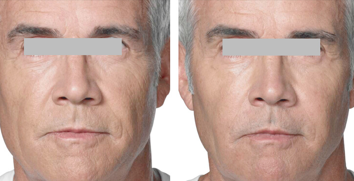 Radiesse antes y después hombre 45 años