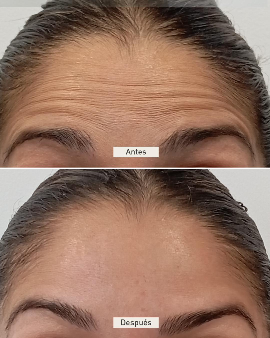 toxina-neuromoduldores-clinicas-dh
