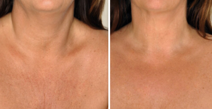 tratamiento-cuello-y-escote-clinicasdh