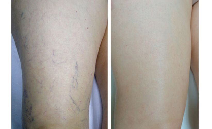 tratamiento-eliminación-varices-arañas-vasculares-escleroterapia-clinicas-dh